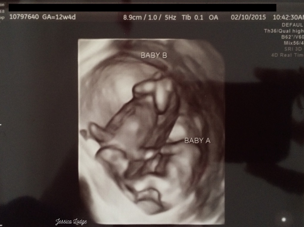 Missed twin ultrasound pictures